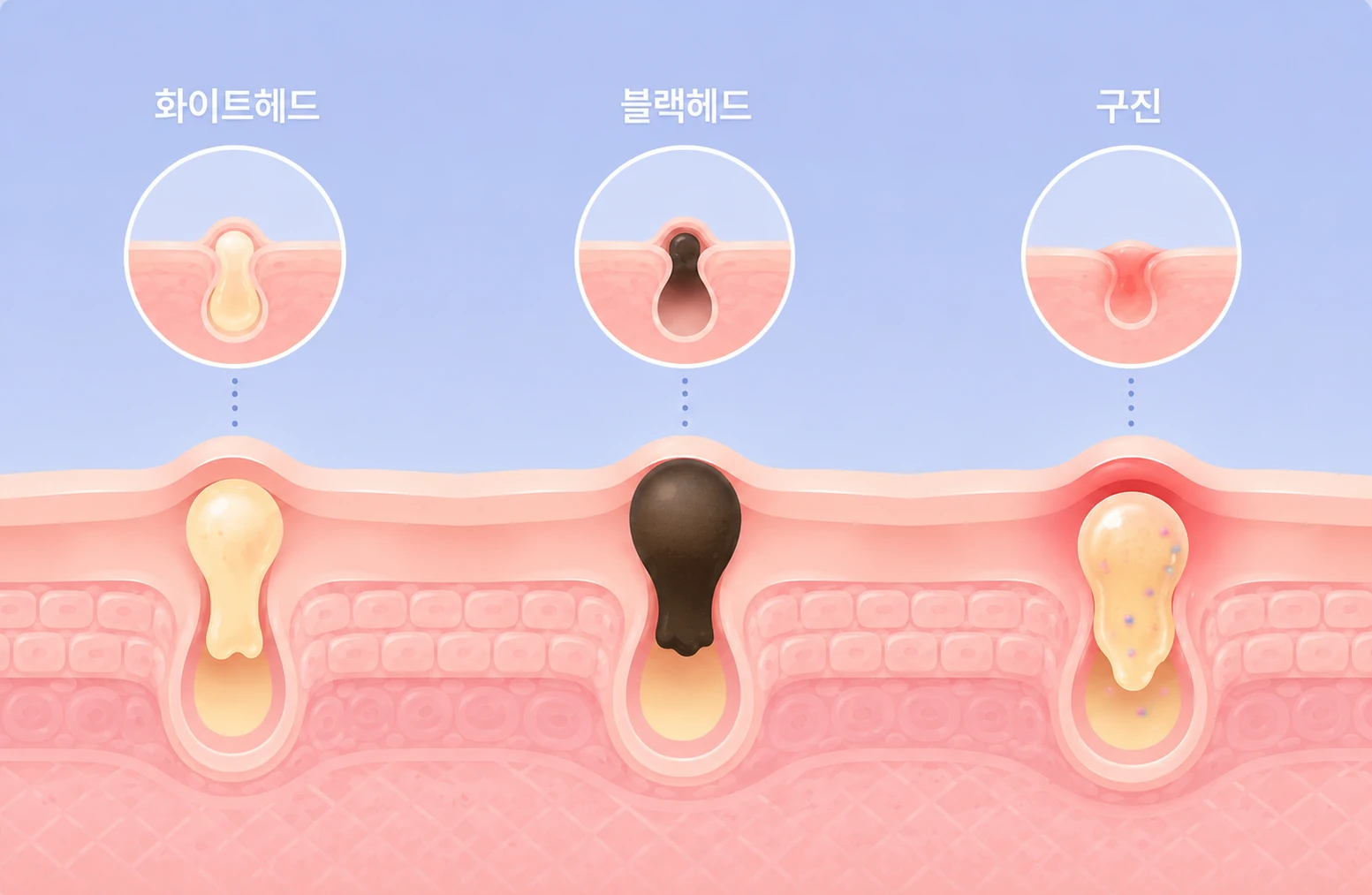 애플토닝 원인 분석 이미지